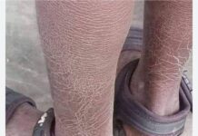 Yadda za ku kawar da kaushi da faso a ƙafafunku Yadda za ku kawar da kaushi da faso a ƙafafunku