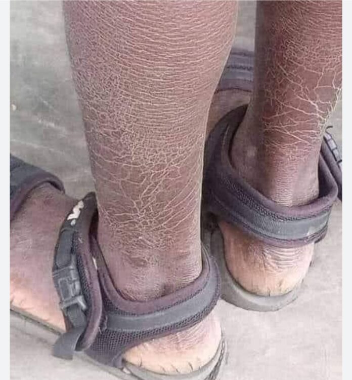 Yadda za ku kawar da kaushi da faso a ƙafafunku